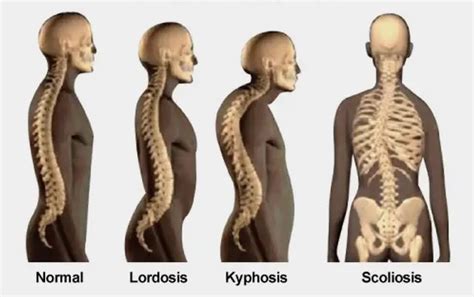 skoliosis torakalis  Kami 081235441701Salah satu jenis skoliosis, yakni levoscoliosis yang bisa menyebabkan tulang belakang bengkok ke sisi kiri tubuh sehingga membentuk huruf C